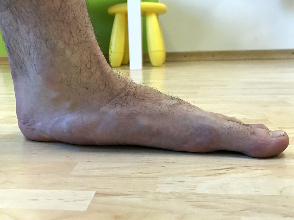 바닥에 디딘 왼발의 옆모습으로, 발 안쪽 아치가 낮아 발바닥이 바닥에 가깝게 닿아 있다.